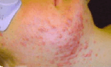Akne vulgaris